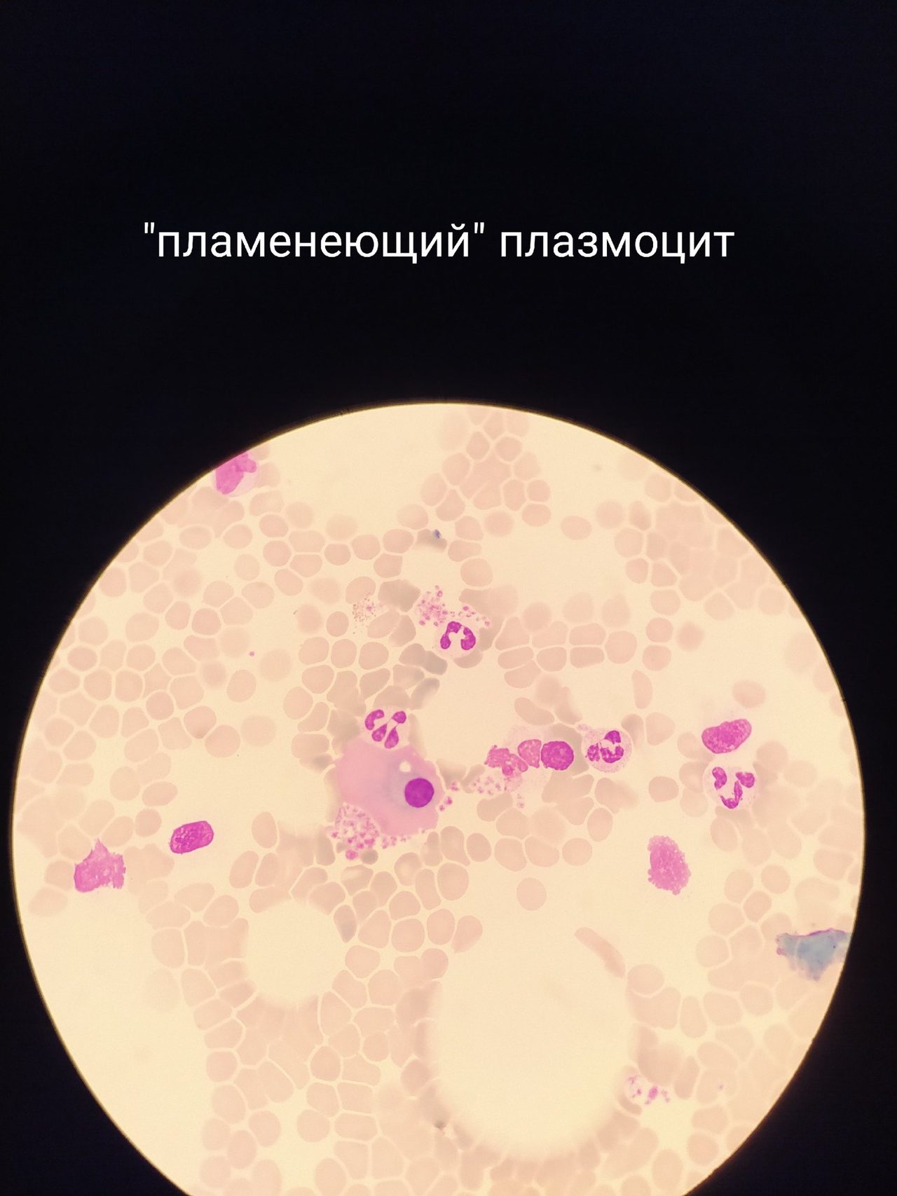 Морфология плазматических клеток и их атипичные формы