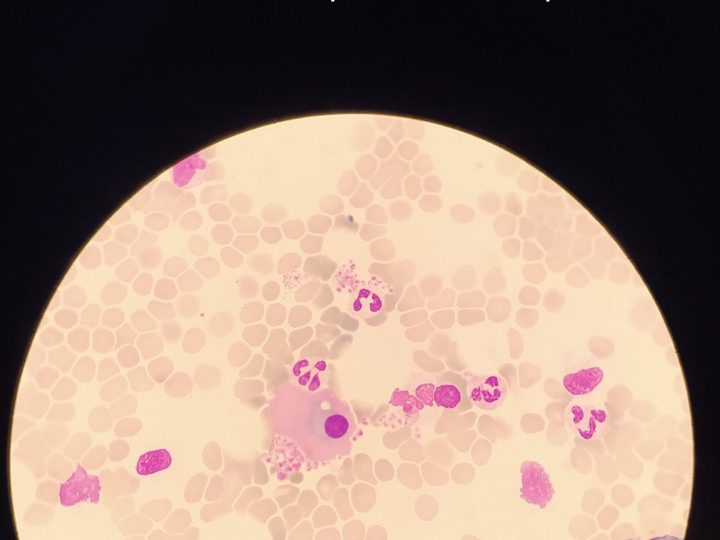 Blood smear, flaming plasma cell with pink staining of the cytoplasm periphery