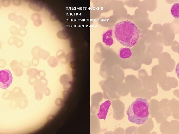 Blood smear, plasma cells with rod-like inclusions in the cytoplasm