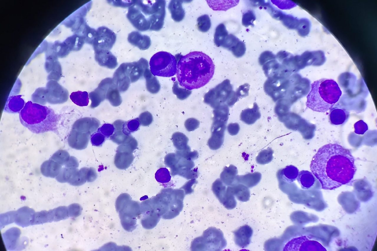 Bone Marrow Plasmocyte Morphology in Multiple Myeloma
