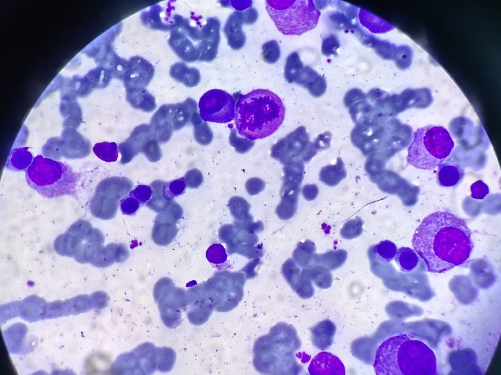 Bone marrow smear: plasma cells and rouleaux formation of erythrocytes