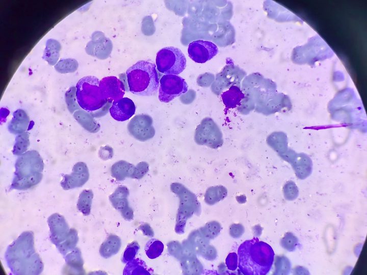 Bone marrow smear: group of atypical plasmocytes with clasmacytosis