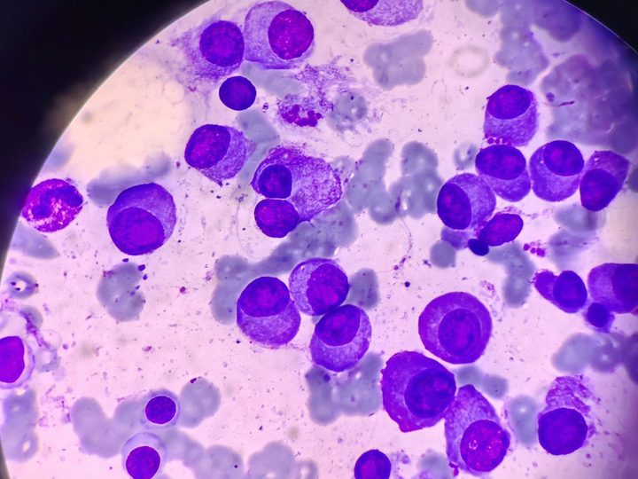 Bone marrow smear: binucleated plasmocyte among plasma cells