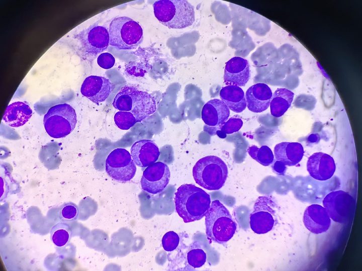 Bone marrow smear: pronounced plasma cell infiltration of the aspirate