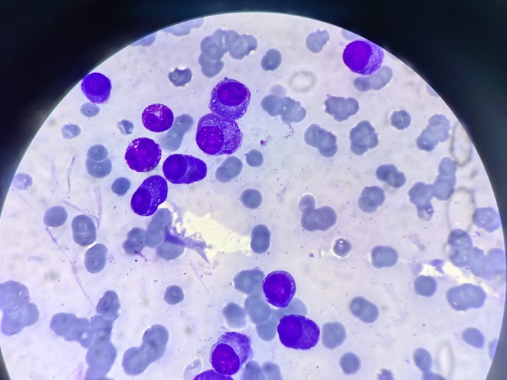 Bone marrow smear: plasmocytes with delicate chromatin and rouleaux formation