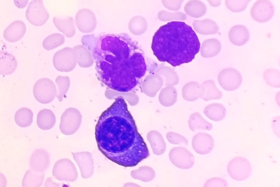 Bone Marrow Plasma Cell Morphology in Myeloma