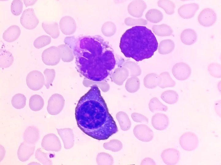 Bone marrow smear: plasma cell with a multi-lobed nucleus and atypia