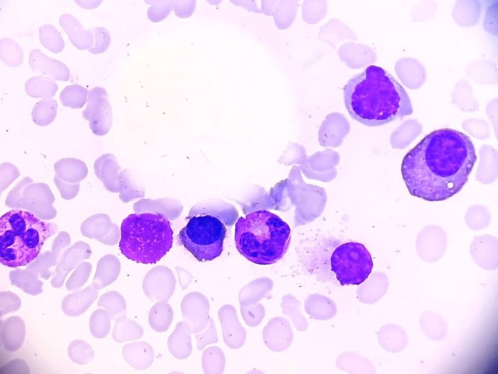 Bone marrow smear: group of plasma cells and a maturing neutrophil