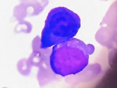 Bone marrow smear: pair of plasma cells with pronounced cytoplasmic basophilia