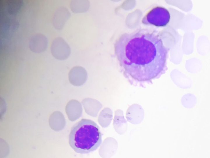 Bone marrow smear: atypical plasma cell with abundant cytoplasm