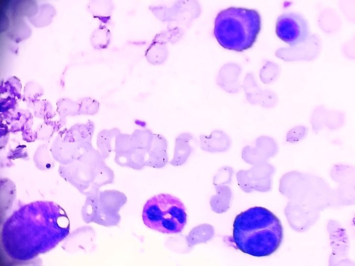 Bone marrow smear: plasma cells with cytoplasmic inclusions and vacuoles