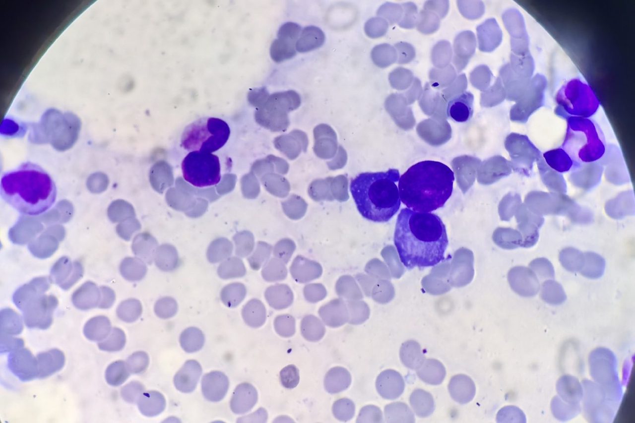 Bone Marrow Plasmocyte Morphology in Myeloma