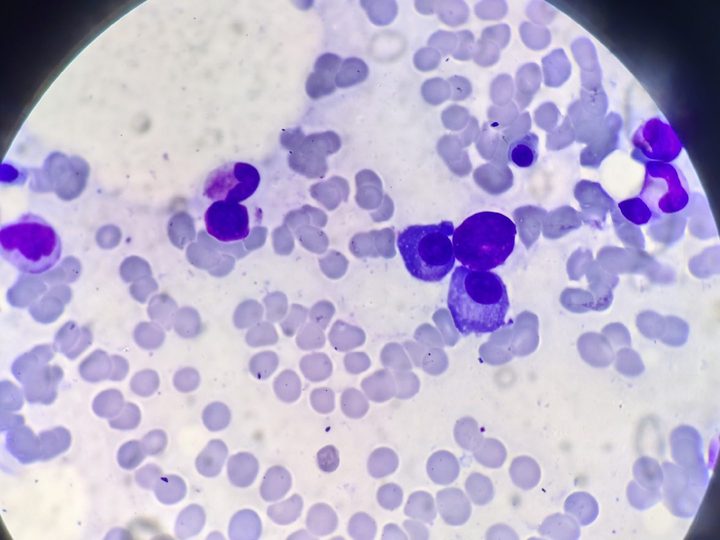 Bone marrow smear: plasmocytes with eccentrically located nuclei
