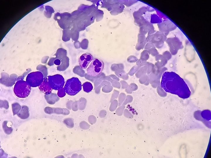 Bone marrow smear: group of plasmocytes and a segmented neutrophil