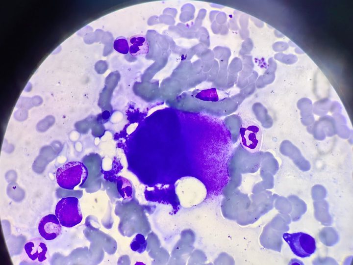 Bone marrow smear: active megakaryocyte with platelet budding
