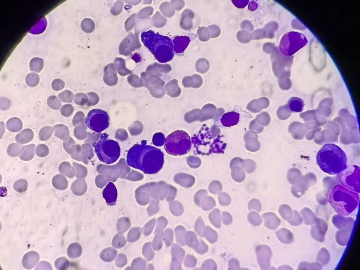 Bone marrow smear: plasma cells and clasmatosis phenomena