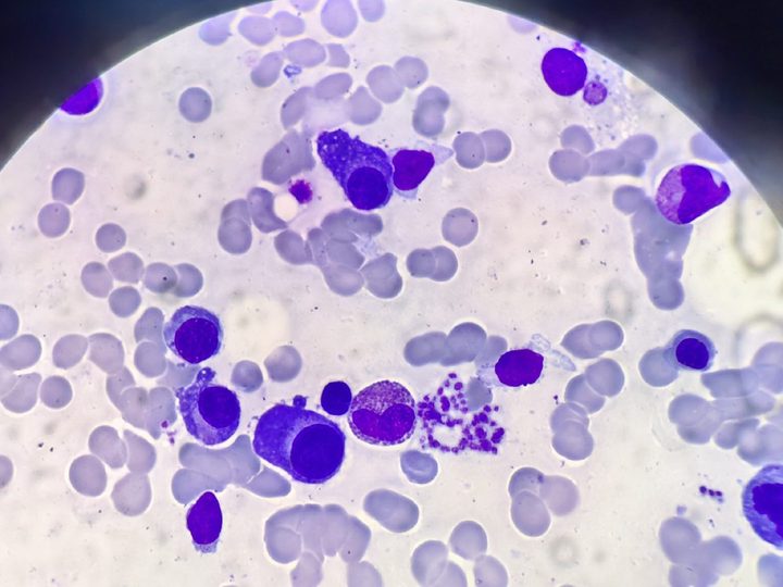 Bone marrow smear: plasmocytes and an eosinophilic granulocyte