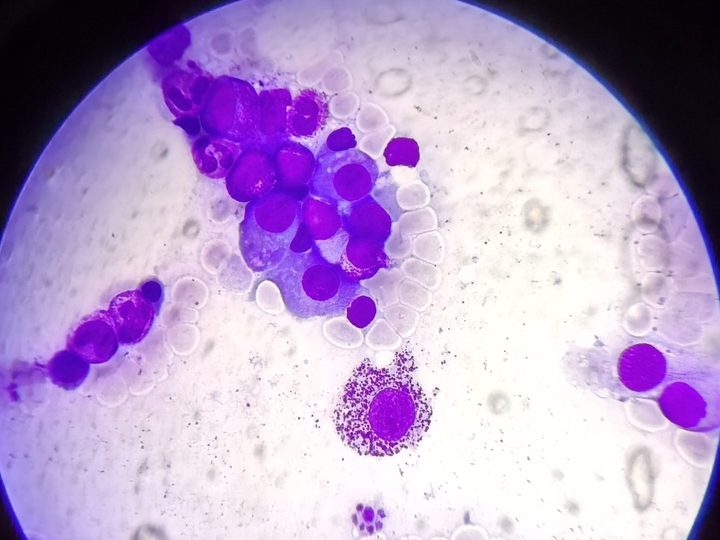 Bone marrow smear: cluster of plasmocytes and a mast cell