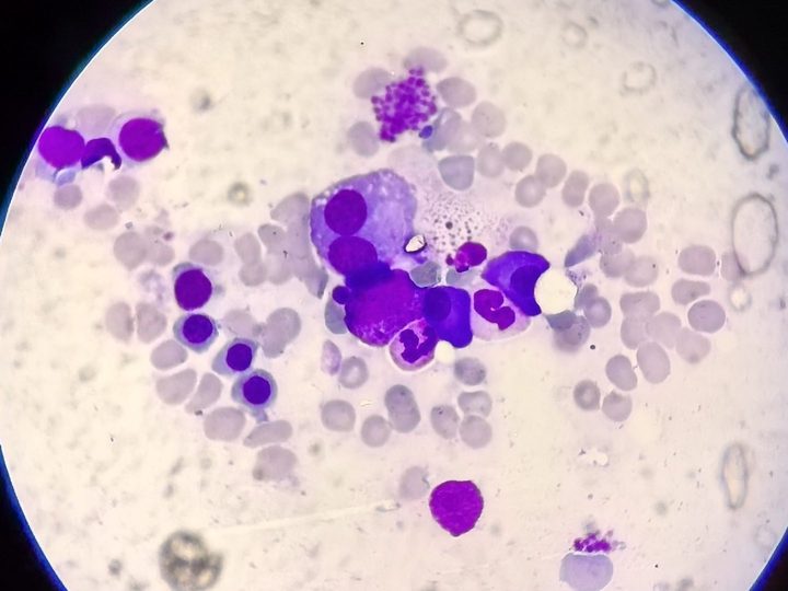 Bone marrow smear: group of plasma cells and cytoplasmic clasmatosis