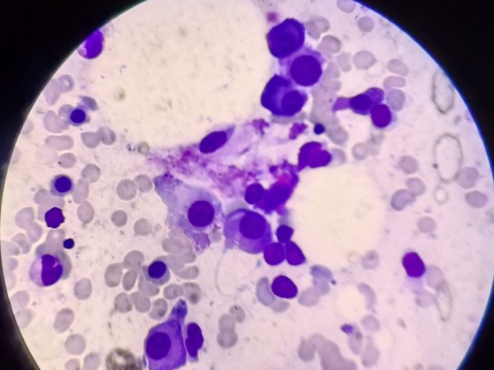 Bone marrow smear: cluster of plasmocytes with signs of atypia