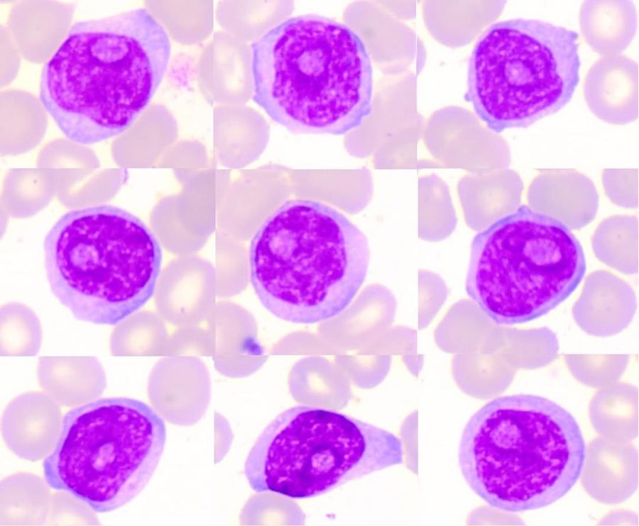 Prolimphocyte Morphology in Peripheral Blood Smears