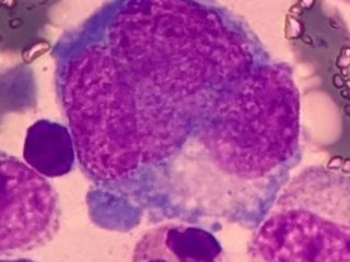 Мазок костного мозга: промегакариоцит с дольчатым ядром и базофильной цитоплазмой