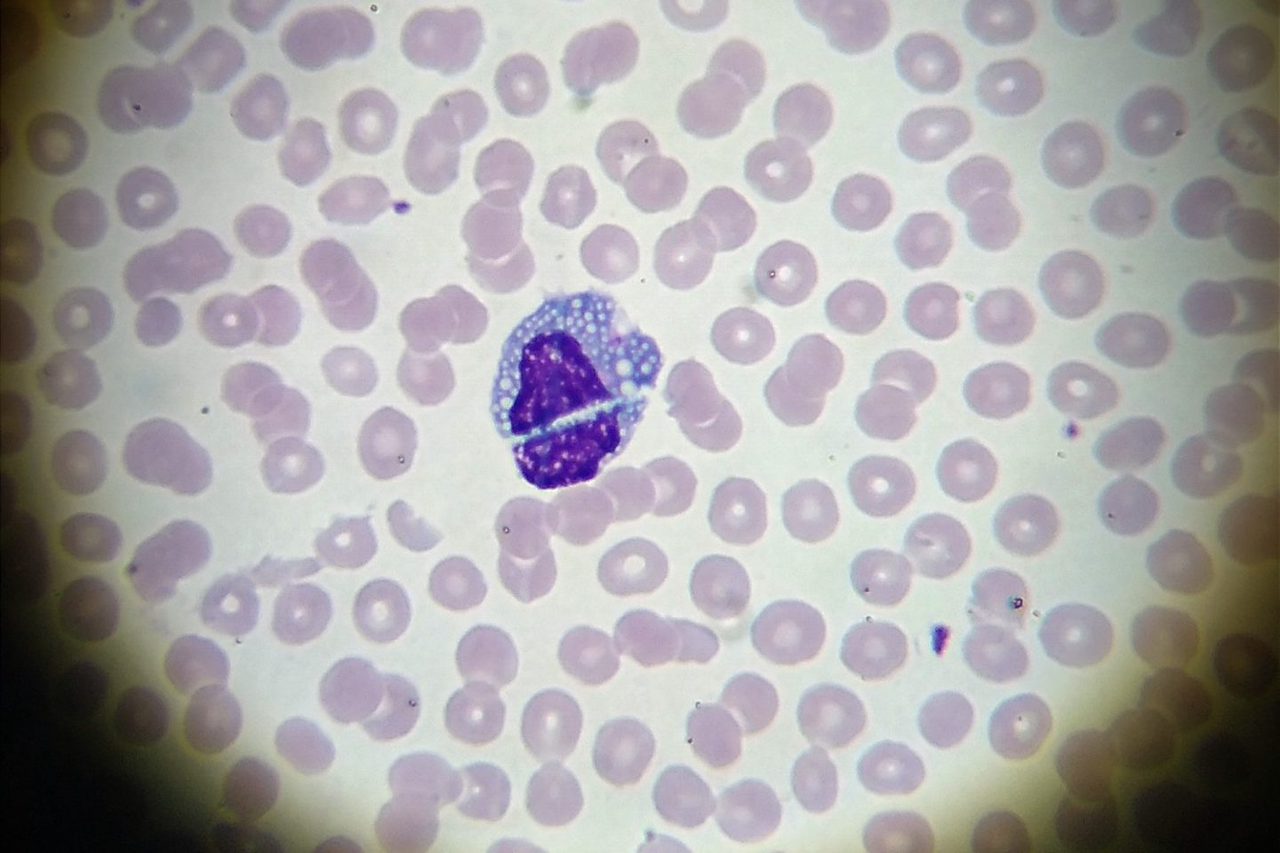 Morphology of Vacuolated Plasma Cells in Blood Smears