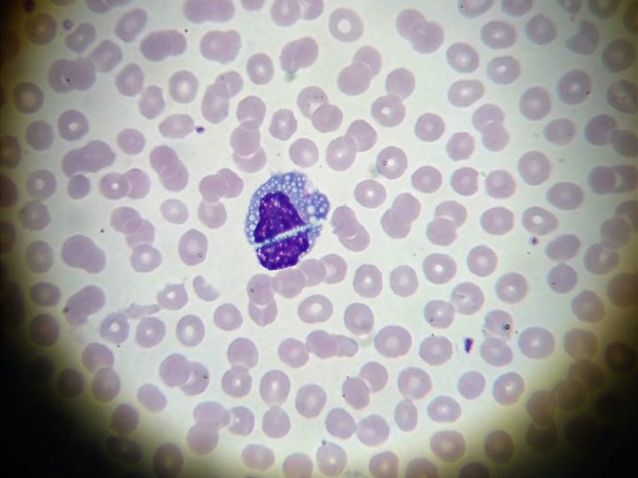 Blood smear: plasma cell with pronounced cytoplasmic vacuolization