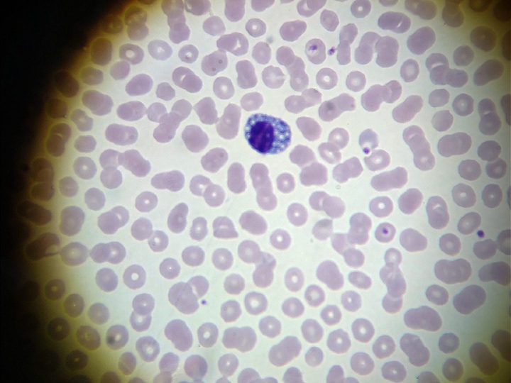 Blood smear: plasmacyte with eccentric nucleus and foamy vacuolization