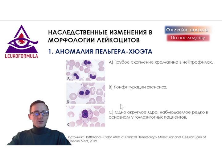 Слайд презентации с морфологией нейтрофилов при аномалии Пельгера — Хюэта