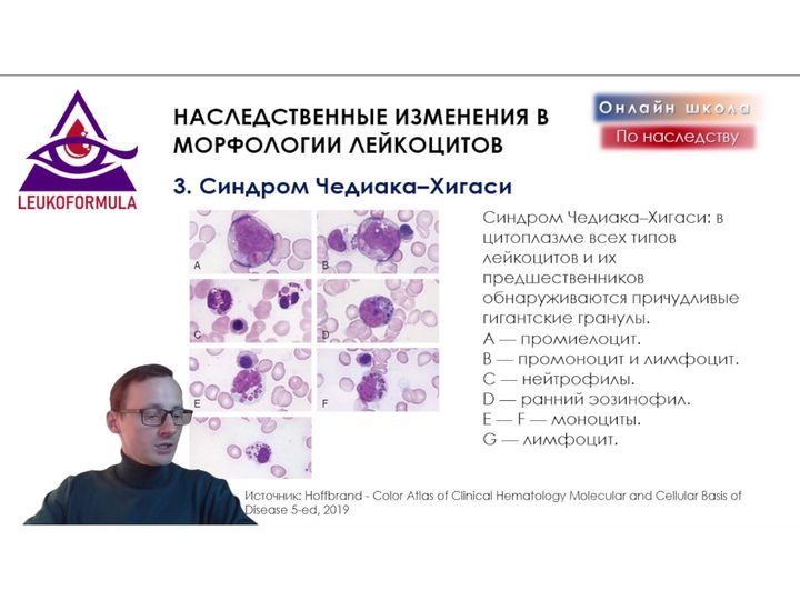 Слайд с гигантскими гранулами в лейкоцитах при синдроме Чедиака — Хигаси