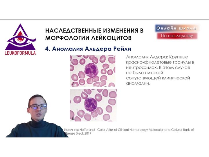 Слайд с крупной азурофильной зернистостью при аномалии Альдера — Рейли