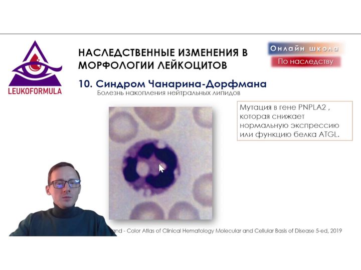 Слайд с вакуолизацией цитоплазмы нейтрофила при синдроме Чанарина — Дорфмана