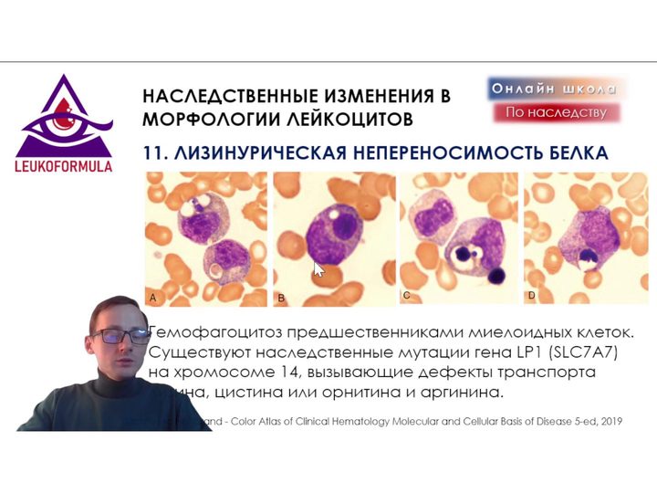 Слайд с гемофагоцитозом миелоидными предшественниками в костном мозге