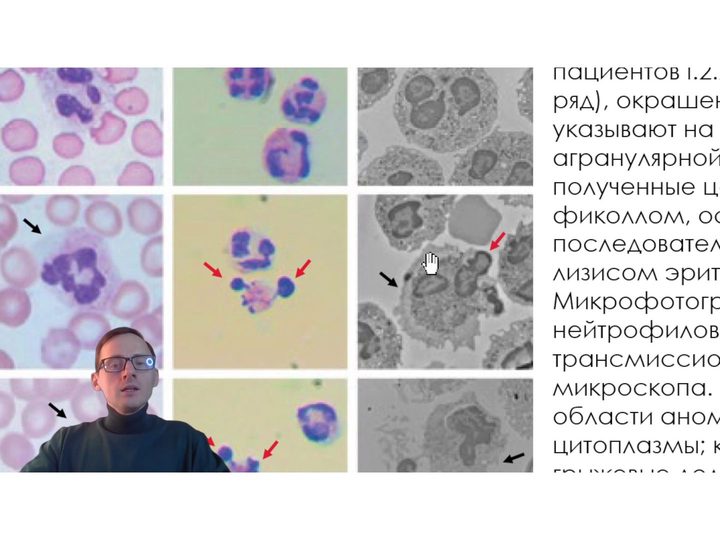 Микрофотографии атипии ядер и агранулярных зон нейтрофилов на слайде