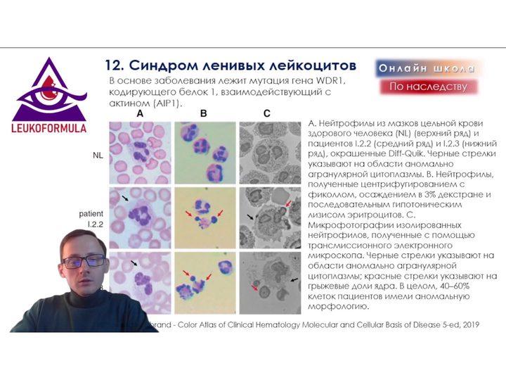 Слайд с ультраструктурными дефектами нейтрофилов при синдроме ленивых лейкоцитов