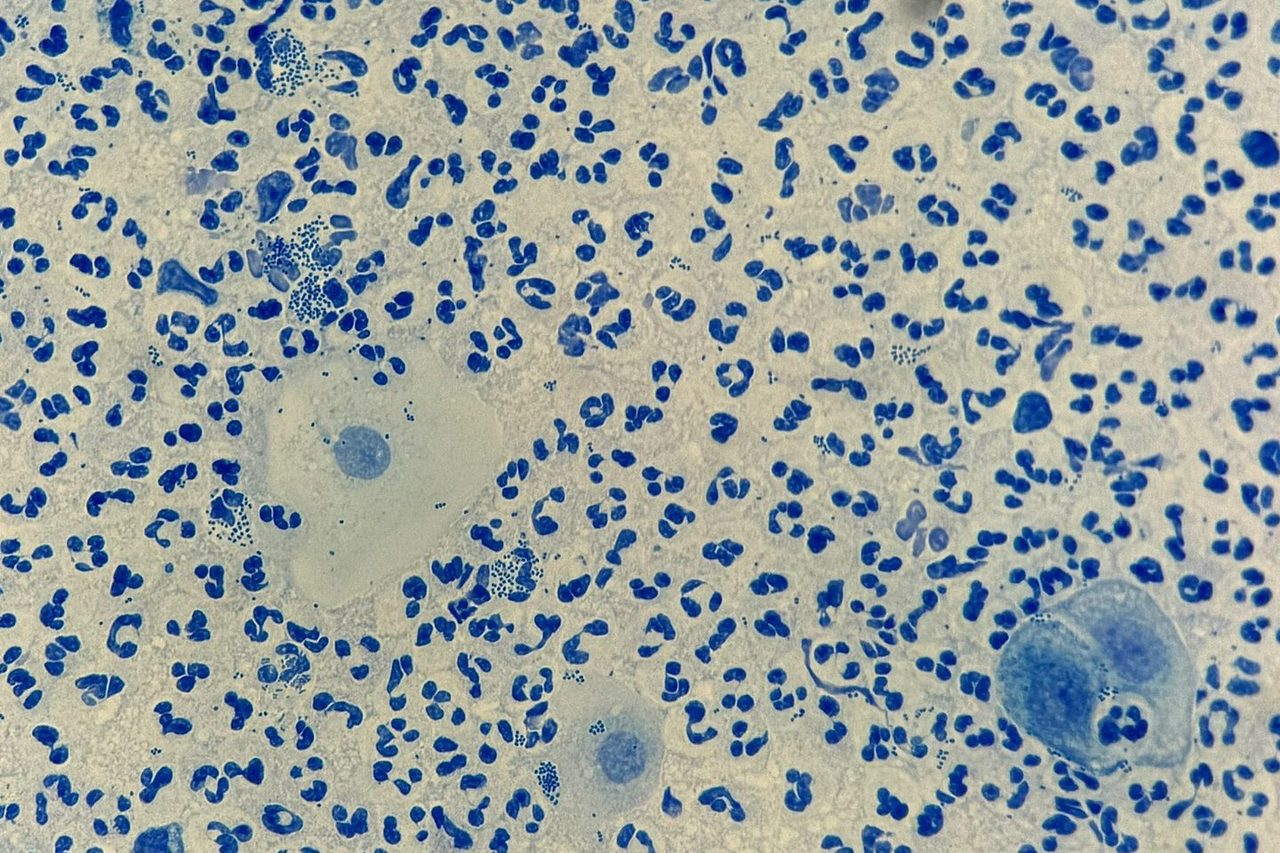 Neisseria gonorrhoeae в мазке из уретры: микроскопия