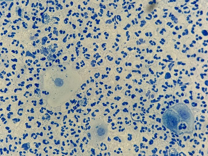 Мазок из уретры: скопление нейтрофилов и диплококки Neisseria gonorrhoeae