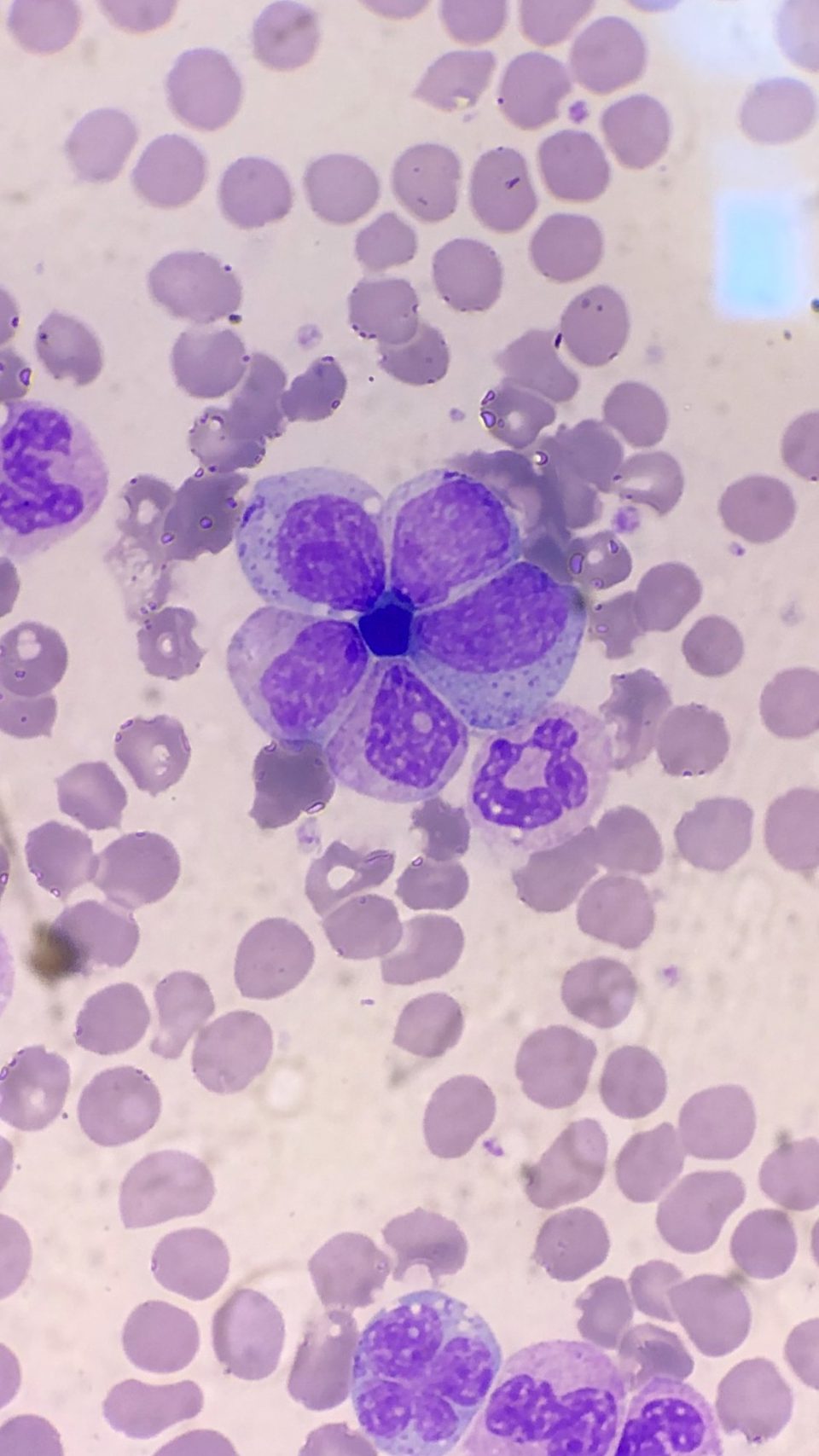 Blood smear, flower-like neutrophil formation under light microscopy