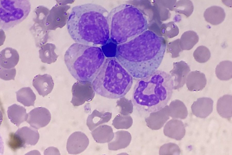 Unusual Neutrophil Clusters in a Blood Smear