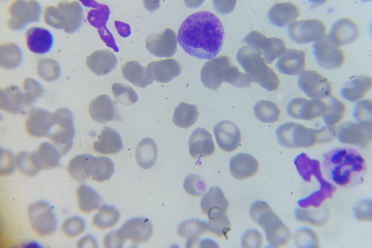 Neutrophilic Myelocytes in Blood Smear During Sepsis
