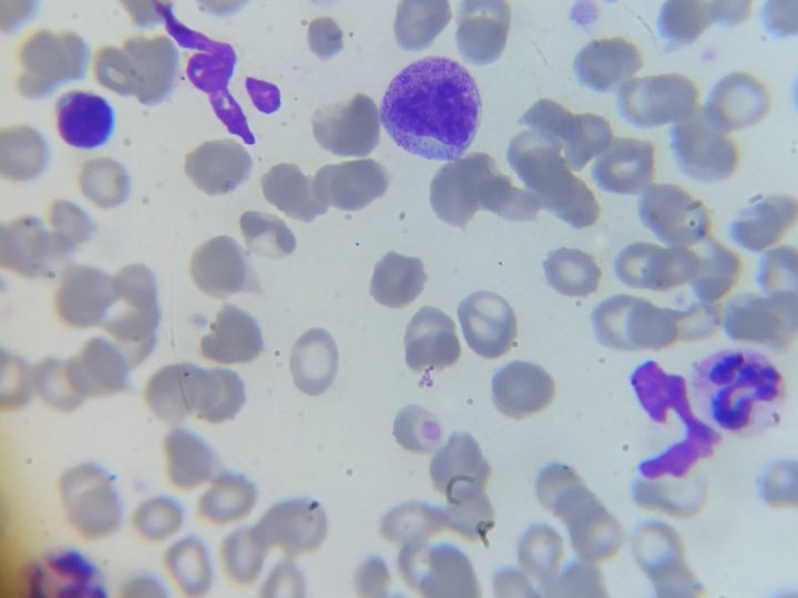 Peripheral blood smear: neutrophilic myelocyte in the center of the field of view
