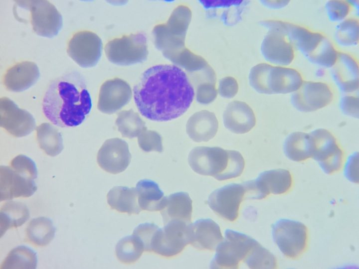 Blood smear: neutrophilic myelocyte surrounded by mature granulocytes
