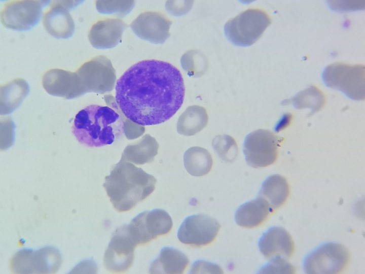 Blood smear: large myelocyte next to a segmented neutrophil