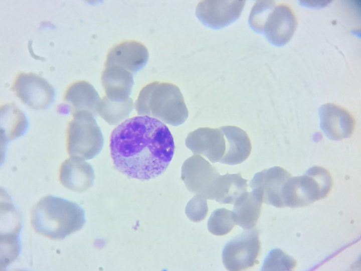 Blood smear: myelocyte with basophilic cytoplasm and granulation