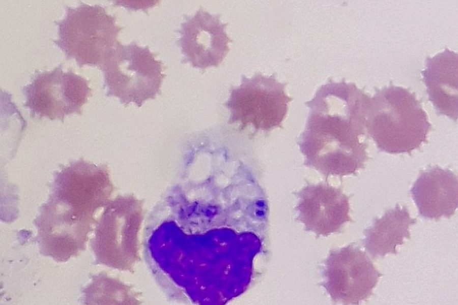 Incomplete Phagocytosis in Neutrophils During Sepsis