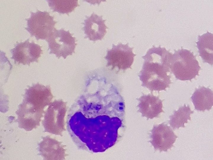 Blood smear: neutrophil with bacteria in cytoplasm and vacuolization