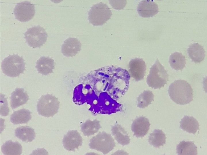 Blood smear: phagocytosed rod-shaped bacteria in a neutrophil