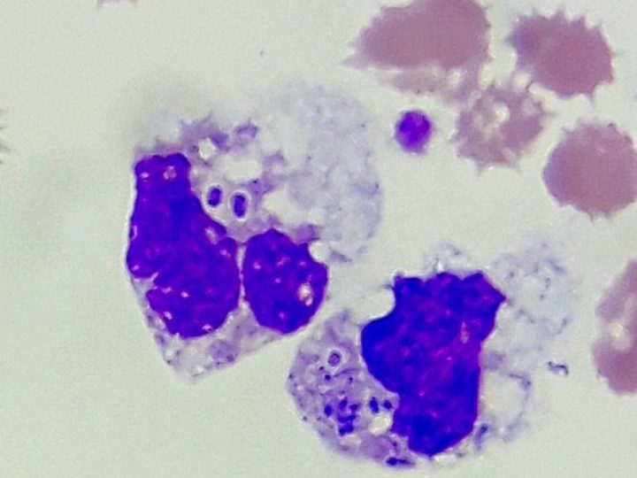Blood smear: neutrophils with a picture of incomplete phagocytosis