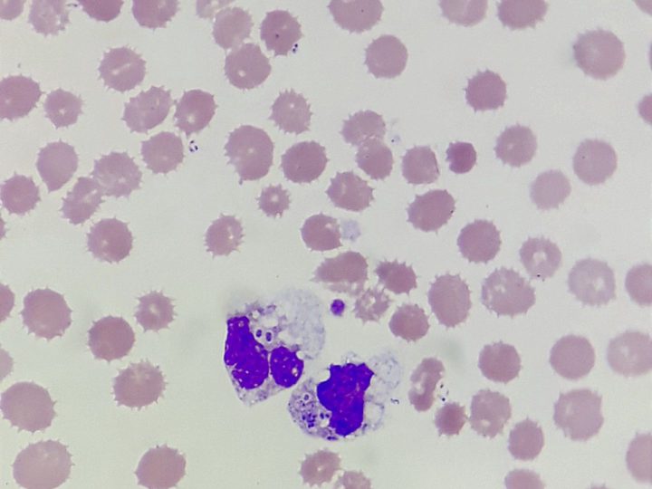 Blood smear: overview field of view with phagocytosing neutrophils